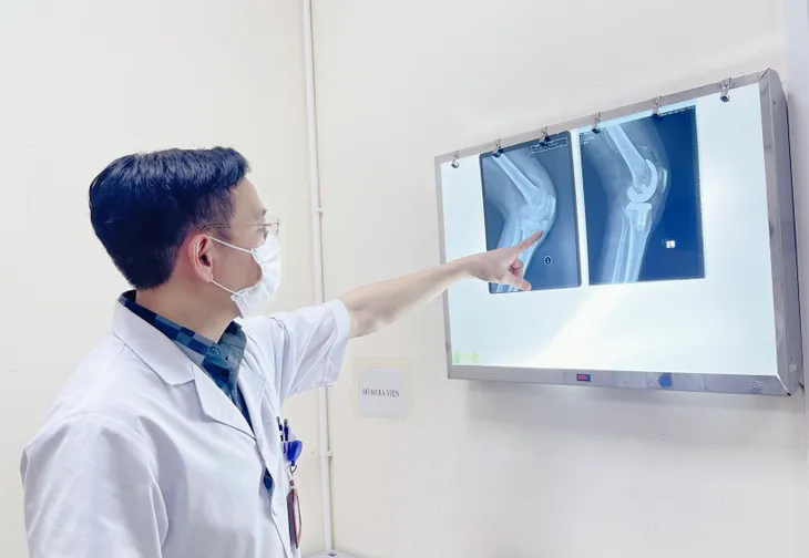 Biến dạng khớp do bệnh gout, bệnh nhân phải phẫu thuật thay khớp gối 2 bên - Ảnh 1. Biến dạng khớp do bệnh gout, bệnh nhân phải phẫu thuật thay khớp gối 2 bên - Ảnh 1.