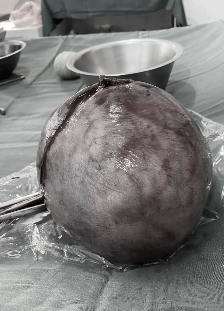 Thấy bụng to bất thường, vào viện phát hiện khối u xơ nặng gần 3kg - Ảnh 1. Thấy bụng to bất thường, vào viện phát hiện khối u xơ nặng gần 3kg - Ảnh 1.