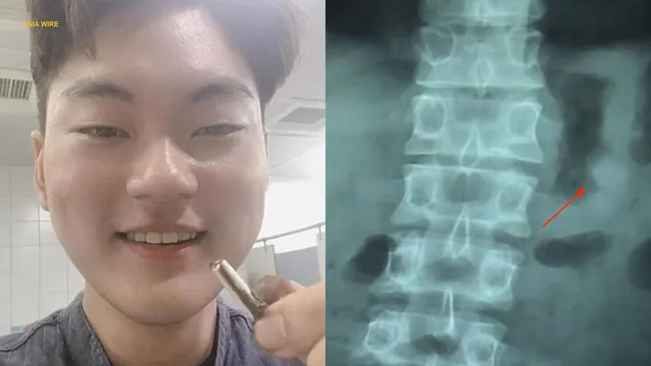 Hy hữu: Nuốt phải tai nghe AirPods khi đang ngủ - Ảnh 2. Hy hữu: Nuốt phải tai nghe AirPods khi đang ngủ - Ảnh 2.