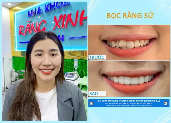 Những ưu điểm vượt trội khi khám tại Nha khoa Răng Xinh thành phố Vinh - Ảnh 3. Những ưu điểm vượt trội khi khám tại Nha khoa Răng Xinh thành phố Vinh - Ảnh 3.