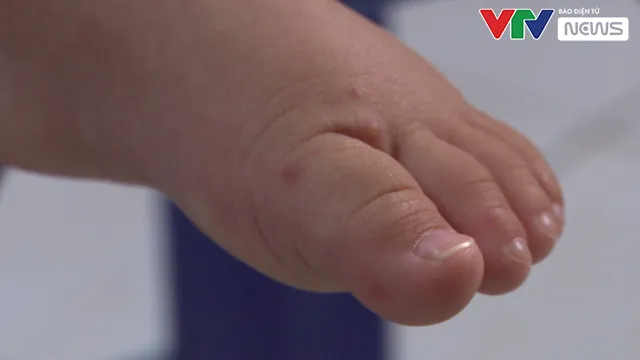 Số trẻ mắc tay chân miệng tăng cao - Ảnh 2. Số trẻ mắc tay chân miệng tăng cao - Ảnh 2.