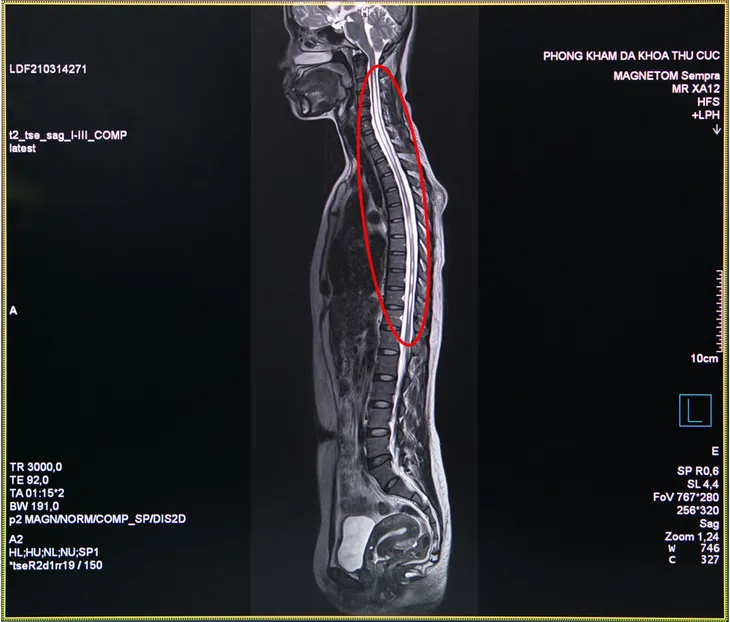 Tưởng bệnh “dân văn phòng”, ai ngờ “ôm” bệnh hiếm nhiều năm - Ảnh 3. Tưởng bệnh “dân văn phòng”, ai ngờ “ôm” bệnh hiếm nhiều năm - Ảnh 3.