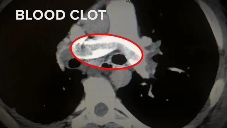 Nguy cơ đông máu do mắc COVID-19 cao hơn tiêm vaccine - Ảnh 1. Nguy cơ đông máu do mắc COVID-19 cao hơn tiêm vaccine - Ảnh 1.