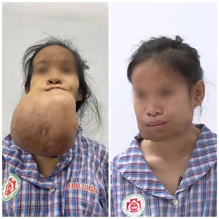 Cô gái trẻ bị biến dạng khuôn mặt vì khối u khổng lồ - Ảnh 1. Cô gái trẻ bị biến dạng khuôn mặt vì khối u khổng lồ - Ảnh 1.