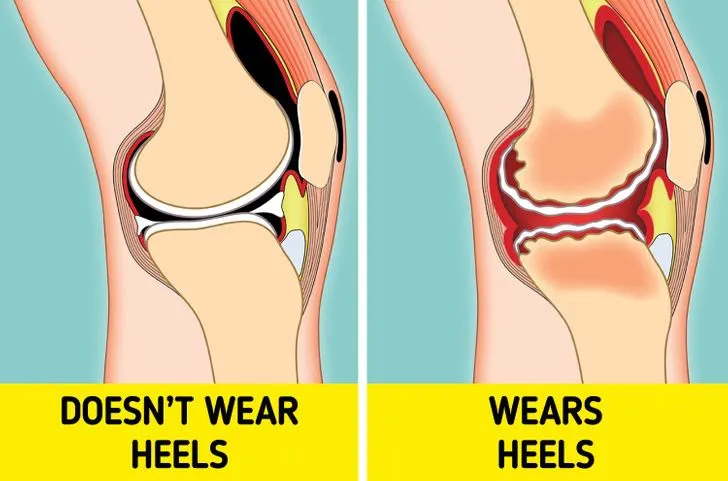 Tác hại khôn lường khi mang giày cao gót hàng ngày - Ảnh 4. Tác hại khôn lường khi mang giày cao gót hàng ngày - Ảnh 4.