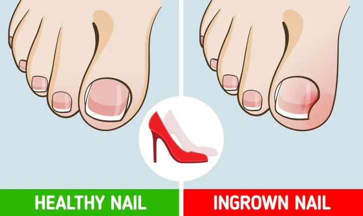 Tác hại khôn lường khi mang giày cao gót hàng ngày - Ảnh 8. Tác hại khôn lường khi mang giày cao gót hàng ngày - Ảnh 8.