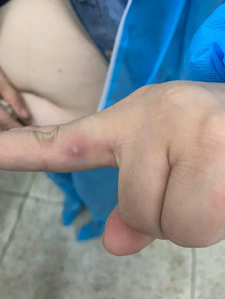Sức khỏe ca mắc đậu mùa khỉ thứ hai tại Việt Nam hiện ra sao? - Ảnh 1. Sức khỏe ca mắc đậu mùa khỉ thứ hai tại Việt Nam hiện ra sao? - Ảnh 1.