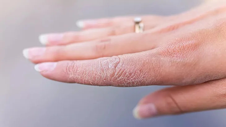 Làm thế nào để chăm sóc làn da khô hiệu quả? - Ảnh 1.