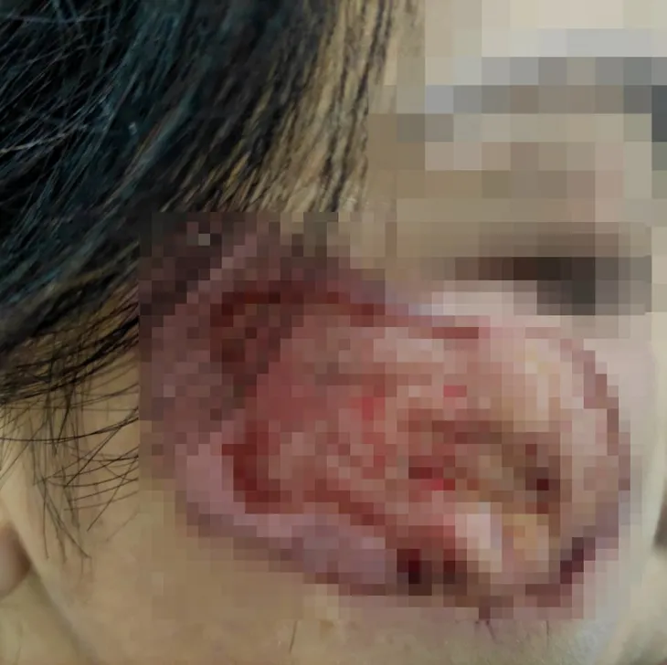 Nhiễm trùng do mua thuốc chứa axit để trị nám - Ảnh 1. Nhiễm trùng do mua thuốc chứa axit để trị nám - Ảnh 1.