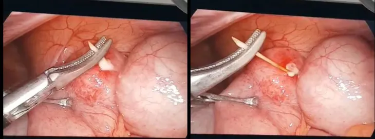 Bé trai 8 tuổi bị thủng ruột non do nuốt phải tăm tre - Ảnh 1. Bé trai 8 tuổi bị thủng ruột non do nuốt phải tăm tre - Ảnh 1.