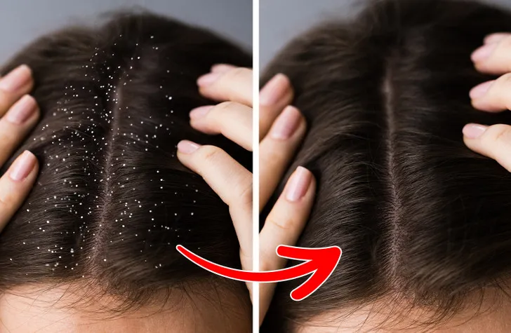 7 bí kíp điều trị hiệu quả tóc gãy rụng, gàu, xơ rối,... - Ảnh 2. 7 bí kíp điều trị hiệu quả tóc gãy rụng, gàu, xơ rối,... - Ảnh 2.