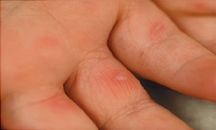 Bệnh tay chân miệng: Nguyên nhân, triệu chứng và các biện pháp phòng ngừa - Ảnh 2. Bệnh tay chân miệng: Nguyên nhân, triệu chứng và các biện pháp phòng ngừa - Ảnh 2.