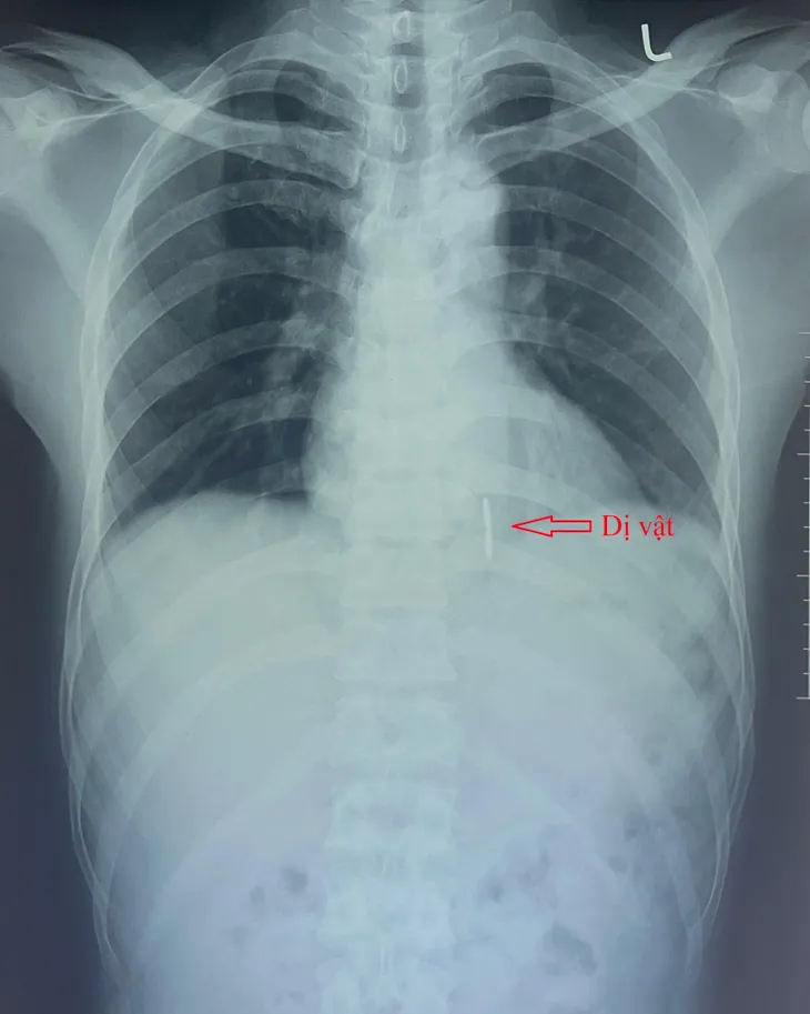 Dùng máy cắt cỏ cắt hàng rào kẽm gai bị dị vật dài 4cm xuyên vào buồng tim - Ảnh 1. Dùng máy cắt cỏ cắt hàng rào kẽm gai bị dị vật dài 4cm xuyên vào buồng tim - Ảnh 1.