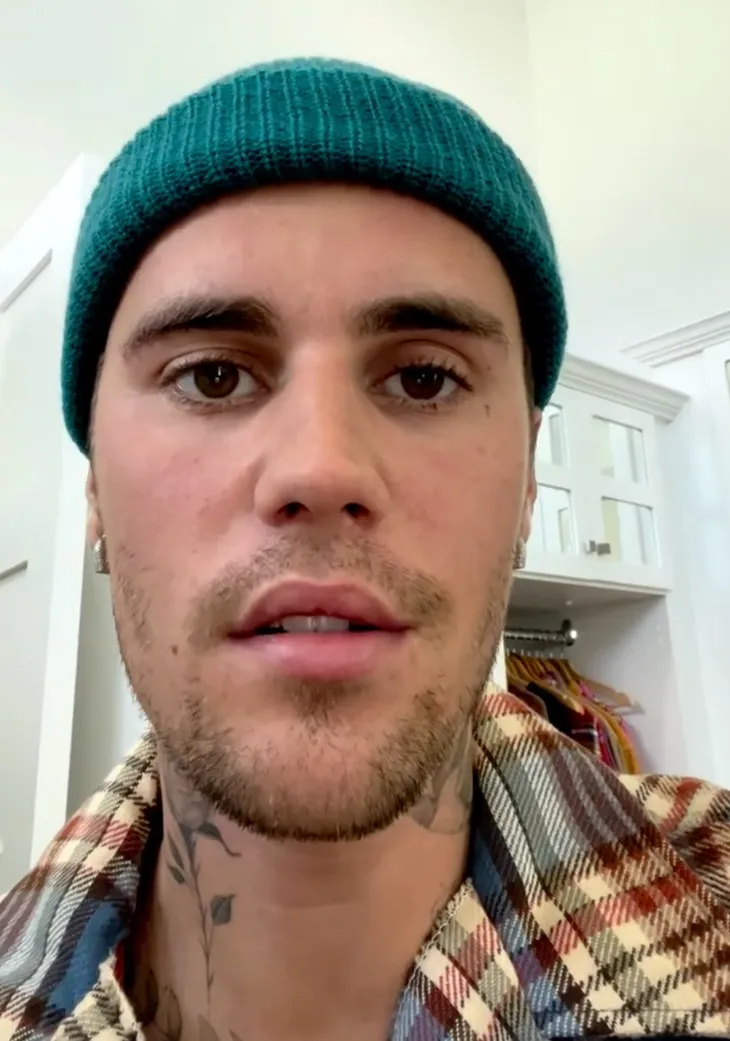 Những điều cần biết về hội chứng Ramsay Hunt đã khiến Justin Bieber liệt nửa mặt - Ảnh 1. Những điều cần biết về hội chứng Ramsay Hunt đã khiến Justin Bieber liệt nửa mặt - Ảnh 1.