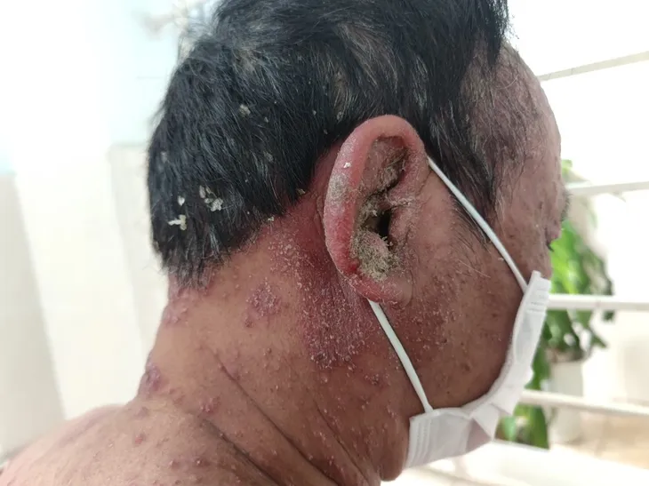 Tin vào quảng cáo thuốc nam sạch của thầy lang - bệnh nhân bị bùng phát vảy nến toàn thân - Ảnh 1.