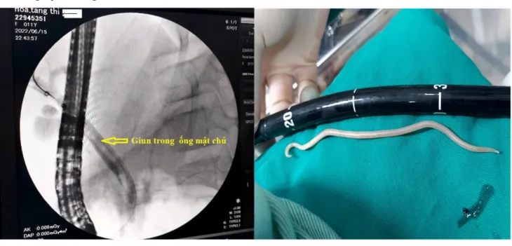 Nội soi gắp giun đũa dài gần 20cm trong ống mật chủ bé gái 11 tuổi - Ảnh 1. Nội soi gắp giun đũa dài gần 20cm trong ống mật chủ bé gái 11 tuổi - Ảnh 1.