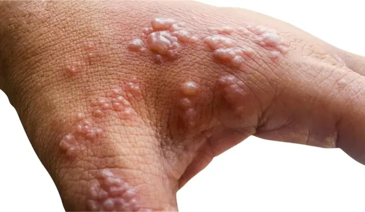 WHO khuyến nghị kiểm soát nguy cơ lây nhiễm bệnh đậu mùa khỉ - Ảnh 1. WHO khuyến nghị kiểm soát nguy cơ lây nhiễm bệnh đậu mùa khỉ - Ảnh 1.