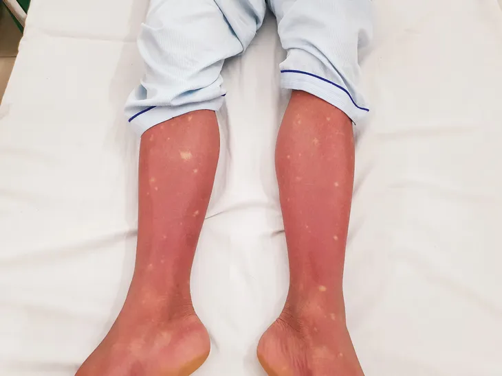 Cảnh giác với nguy cơ bùng phát dịch sốt xuất huyết Dengue ở miền Bắc - Ảnh 2. Cảnh giác với nguy cơ bùng phát dịch sốt xuất huyết Dengue ở miền Bắc - Ảnh 2.