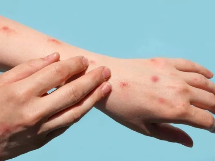Rác thải y tế có thể khiến virus bệnh đậu mùa khỉ lây lan - Ảnh 1. Rác thải y tế có thể khiến virus bệnh đậu mùa khỉ lây lan - Ảnh 1.