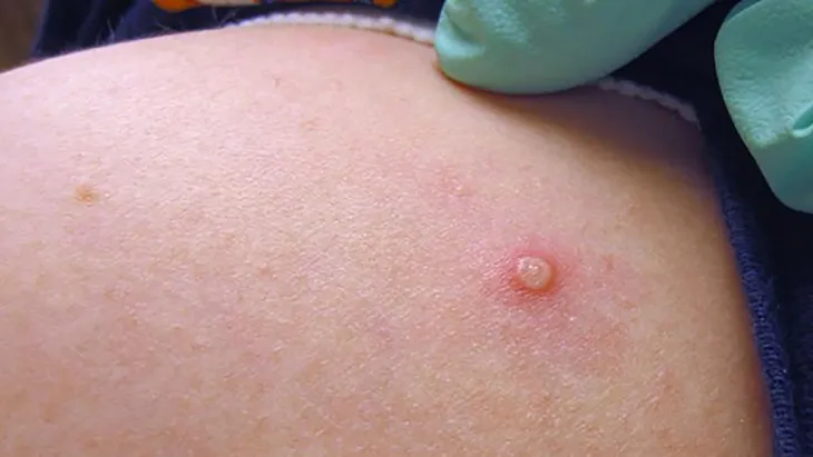 Cảnh báo virus đậu mùa khỉ có thể đã âm thầm lây lan - Ảnh 1. Cảnh báo virus đậu mùa khỉ có thể đã âm thầm lây lan - Ảnh 1.