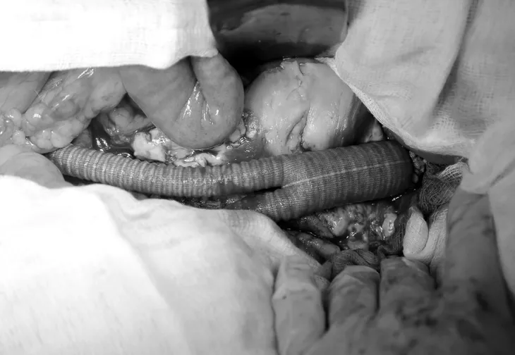 Cảnh giác với căn bệnh nguy hiểm: Phình động mạch chủ bụng - Ảnh 1.