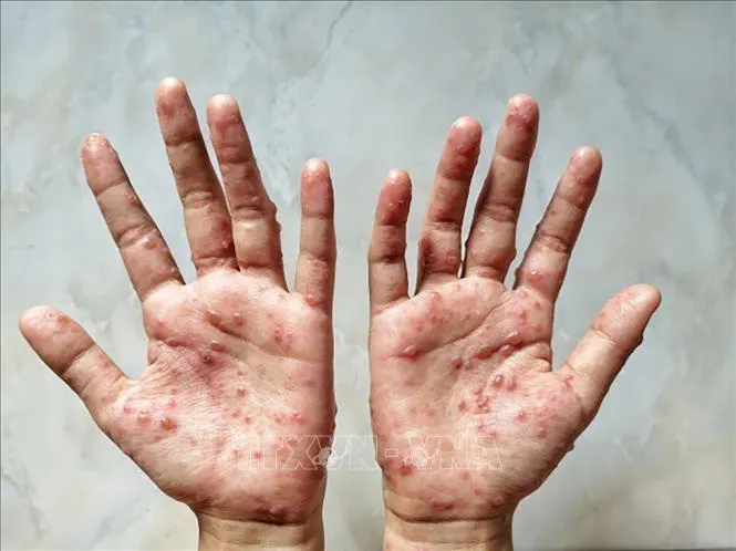 Mỹ ghi nhận trường hợp mắc COVID-19 và đậu mùa khỉ cùng lúc - Ảnh 1. Mỹ ghi nhận trường hợp mắc COVID-19 và đậu mùa khỉ cùng lúc - Ảnh 1.