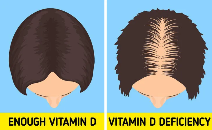 6 dấu hiệu cảnh báo cơ thể bạn đang thiếu Vitamin D trầm trọng - Ảnh 1. 6 dấu hiệu cảnh báo cơ thể bạn đang thiếu Vitamin D trầm trọng - Ảnh 1.