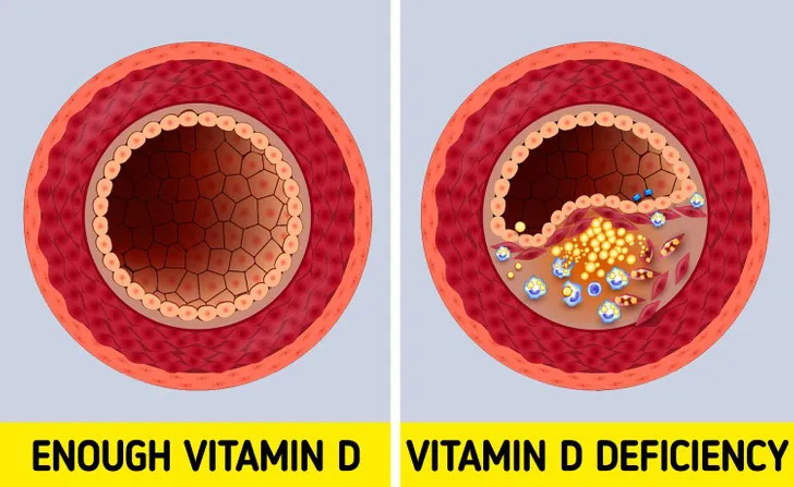 6 dấu hiệu cảnh báo cơ thể bạn đang thiếu Vitamin D trầm trọng - Ảnh 3. 6 dấu hiệu cảnh báo cơ thể bạn đang thiếu Vitamin D trầm trọng - Ảnh 3.