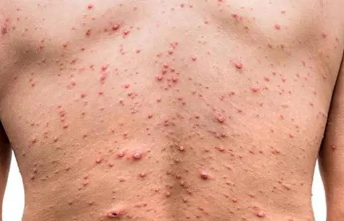 Canada đẩy mạnh tiêm vaccine phòng đậu mùa khỉ - Ảnh 1. Canada đẩy mạnh tiêm vaccine phòng đậu mùa khỉ - Ảnh 1.