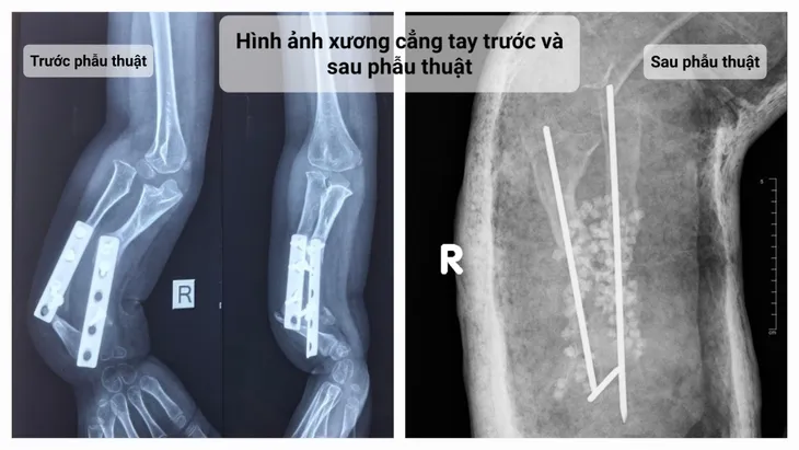 Bé gái 5 tuổi mắc bệnh khớp giả bẩm sinh 2 xương cẳng tay cực hiếm gặp - Ảnh 1. Bé gái 5 tuổi mắc bệnh khớp giả bẩm sinh 2 xương cẳng tay cực hiếm gặp - Ảnh 1.