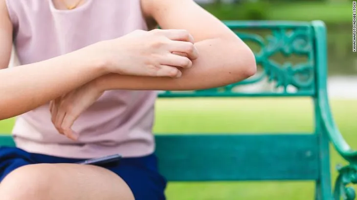 Tại sao muỗi đốt lại gây ngứa cho da? - Ảnh 1. Tại sao muỗi đốt lại gây ngứa cho da? - Ảnh 1.