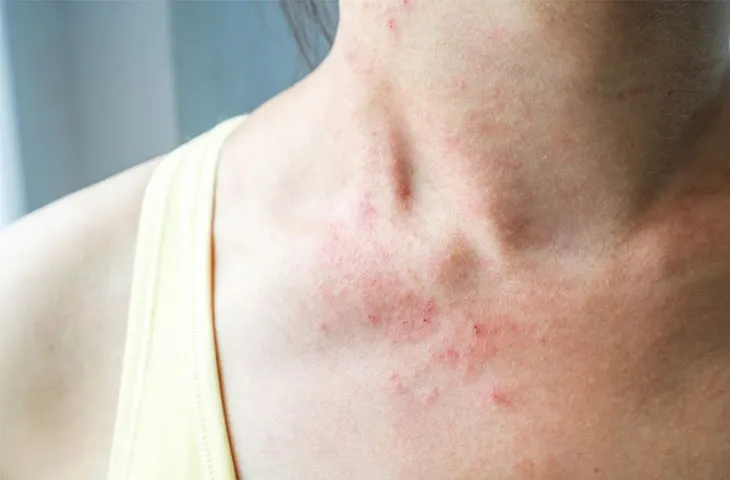 Ăn trứng gà có bị dị ứng không? - Ảnh 1. Ăn trứng gà có bị dị ứng không? - Ảnh 1.