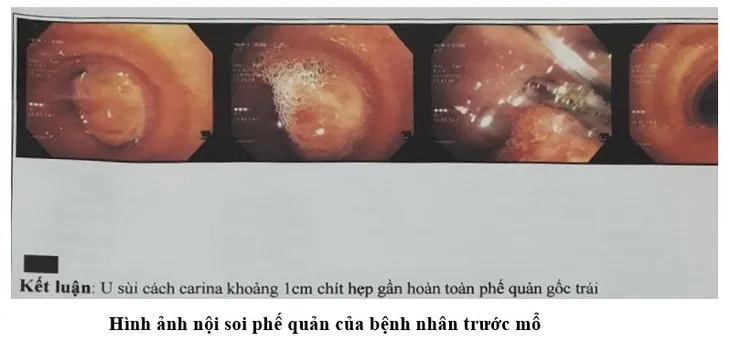 Đi khám vì đột ngột ho ra máu, nam thanh niên phát hiện u ác tính hiếm gặp - Ảnh 1. Đi khám vì đột ngột ho ra máu, nam thanh niên phát hiện u ác tính hiếm gặp - Ảnh 1.