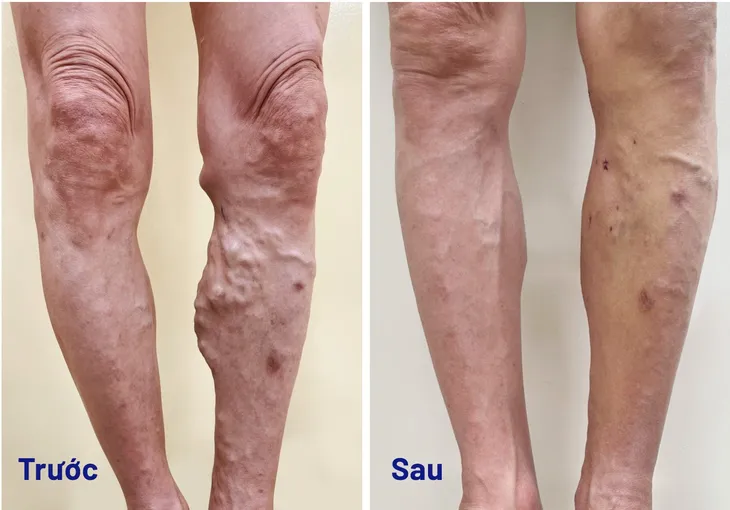Bệnh lý khiến người phụ nữ sáng đi giày bình thường, chiều về chật cứng - Ảnh 1. Bệnh lý khiến người phụ nữ sáng đi giày bình thường, chiều về chật cứng - Ảnh 1.
