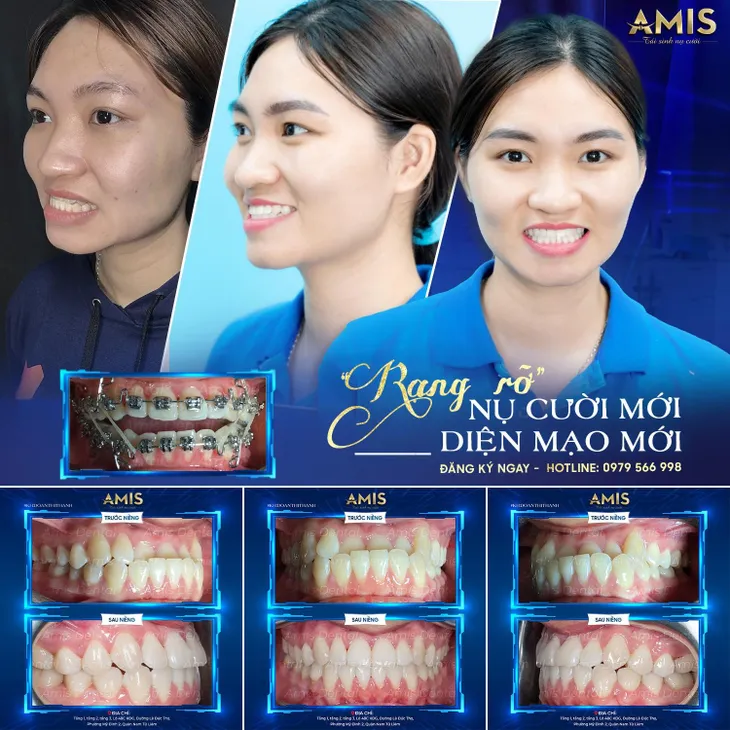 Nha khoa Amis - Điểm đến tin cậy cho nụ cười hoàn hảo - Ảnh 2. Nha khoa Amis - Điểm đến tin cậy cho nụ cười hoàn hảo - Ảnh 2.