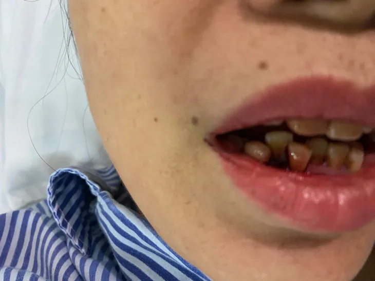 Cảnh báo: Người bệnh đái tháo đường mắc sốt xuất huyết dễ có nguy cơ biến chứng nặng - Ảnh 1.
