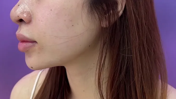 Hậu phẫu thuật nâng mũi, bác sĩ thẩm mỹ cảnh báo dấu hiệu bất thường - Ảnh 2. Hậu phẫu thuật nâng mũi, bác sĩ thẩm mỹ cảnh báo dấu hiệu bất thường - Ảnh 2.