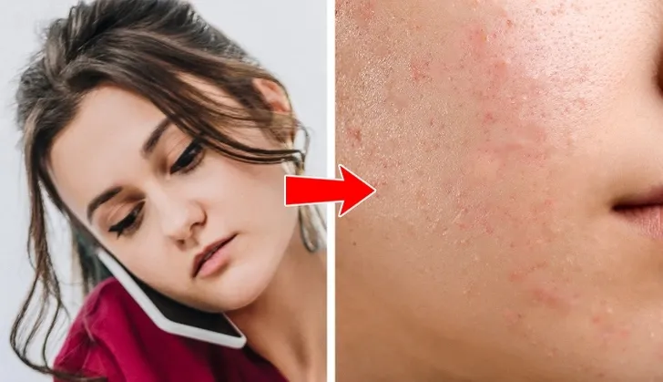 Tại sao mụn thường xuất hiện ở 8 vùng này trên cơ thể? - Ảnh 1. Tại sao mụn thường xuất hiện ở 8 vùng này trên cơ thể? - Ảnh 1.
