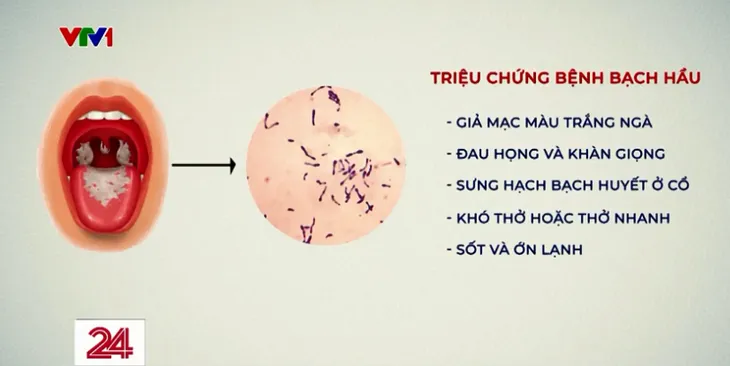 Vì sao bệnh bạch hầu xuất hiện ở nhiều tỉnh, thành - Ảnh 1. Vì sao bệnh bạch hầu xuất hiện ở nhiều tỉnh, thành - Ảnh 1.