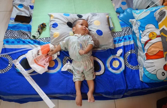 Indonesia: Thảm cảnh những nạn nhân sống sót phải gánh chịu sau bê bối siro ho nhiễm độc - Ảnh 1. Indonesia: Thảm cảnh những nạn nhân sống sót phải gánh chịu sau bê bối siro ho nhiễm độc - Ảnh 1.