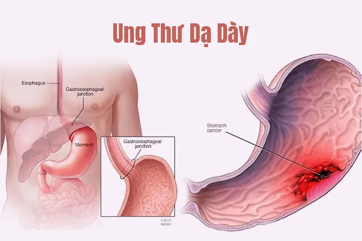 ung-thu-da-day-song-duoc-bao-lau1-163011815907774515423-1682303782 ung-thu-da-day-song-duoc-bao-lau1-163011815907774515423-1682303782