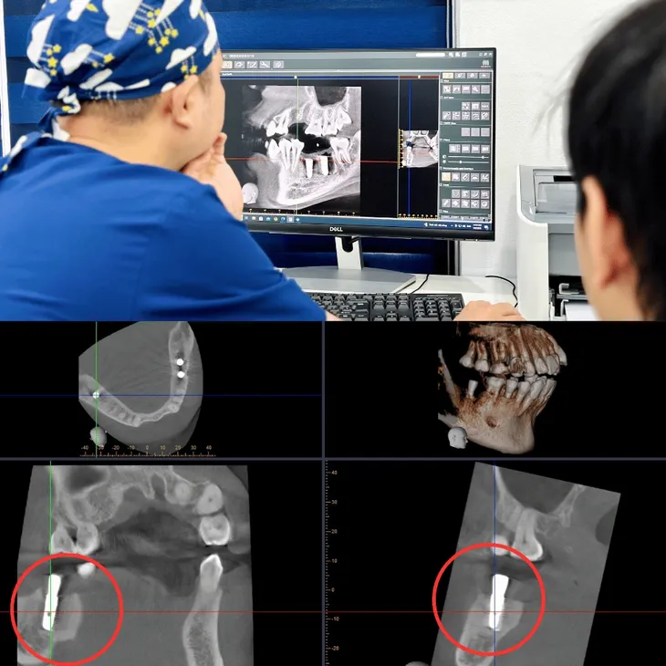 Nha khoa ViDental trồng răng bằng công nghệ từ tính, không khoan xương - Ảnh 2. Nha khoa ViDental trồng răng bằng công nghệ từ tính, không khoan xương - Ảnh 2.