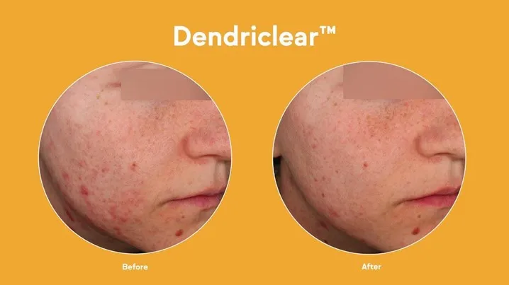 S-Skin ra mắt bộ bốn “siêu phẩm” trị mụn, mờ thâm phiên bản nâng cấp - Ảnh 3. S-Skin ra mắt bộ bốn “siêu phẩm” trị mụn, mờ thâm phiên bản nâng cấp - Ảnh 3.