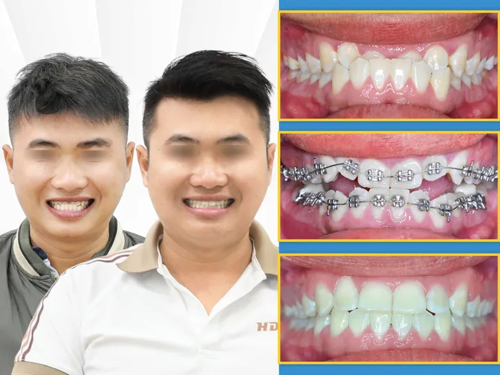 Nguyên nhân khiến kết quả niềng răng thất bại - Ảnh 1. Nguyên nhân khiến kết quả niềng răng thất bại - Ảnh 1.