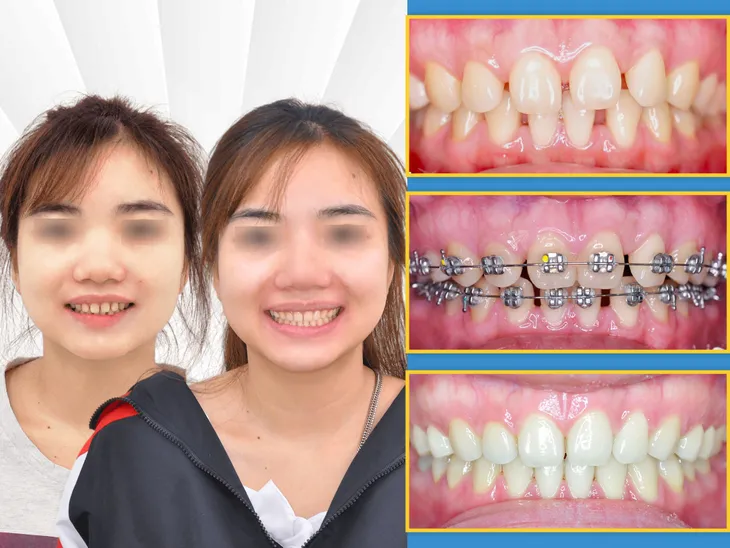 Nguyên nhân khiến kết quả niềng răng thất bại - Ảnh 3. Nguyên nhân khiến kết quả niềng răng thất bại - Ảnh 3.