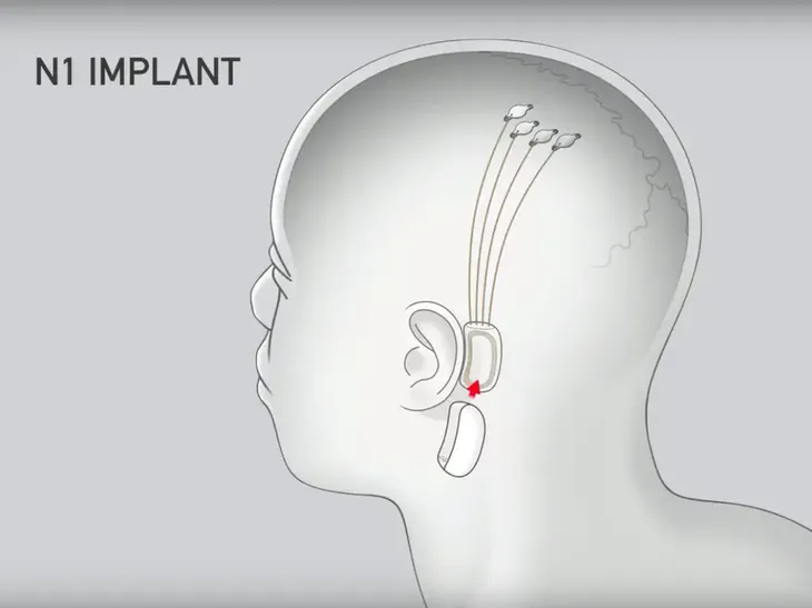 Triển vọng thử nghiệm cấy chip của công ty Neuralink - Ảnh 1. Triển vọng thử nghiệm cấy chip của công ty Neuralink - Ảnh 1.