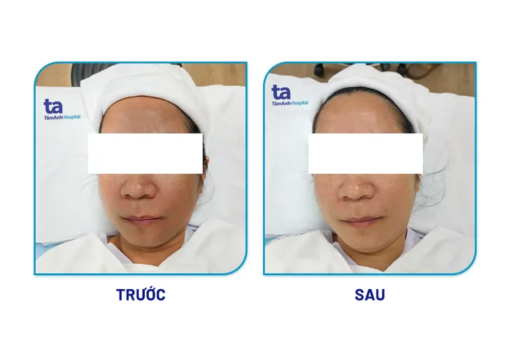 Vượt hàng trăm cây số đi xóa nám công nghệ Mỹ - Ảnh 2. Vượt hàng trăm cây số đi xóa nám công nghệ Mỹ - Ảnh 2.