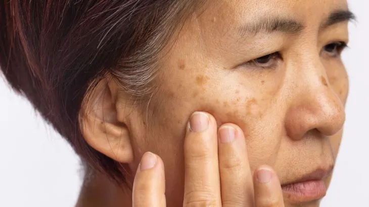 10 tình trạng về da phổ biến nhất bạn cần biết - Ảnh 3.