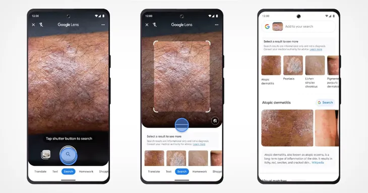 Google ra mắt công cụ chẩn đoán sức khỏe làn da qua ảnh chụp - Ảnh 1.
