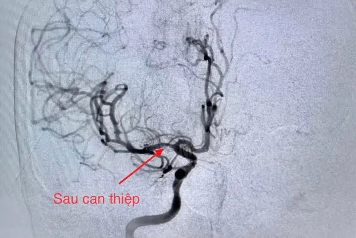 Cứu sống bệnh nhân cùng lúc bị nhồi máu cơ tim và đột quỵ - Ảnh 2. Cứu sống bệnh nhân cùng lúc bị nhồi máu cơ tim và đột quỵ - Ảnh 2.